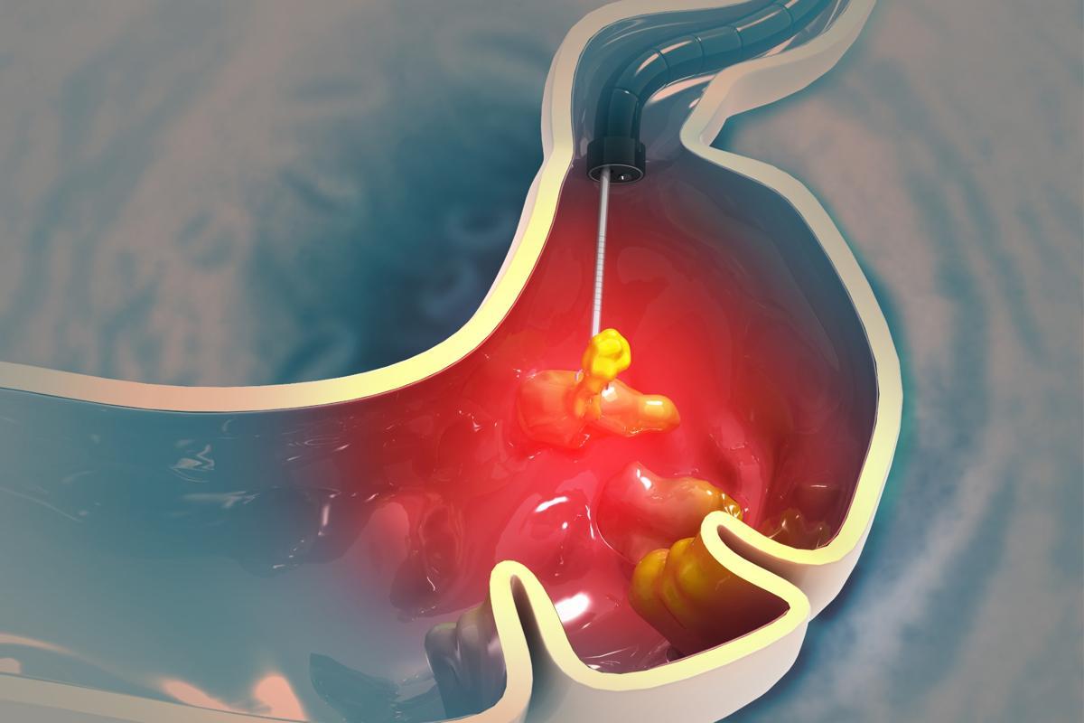 환급형암보험 환급률 비교표